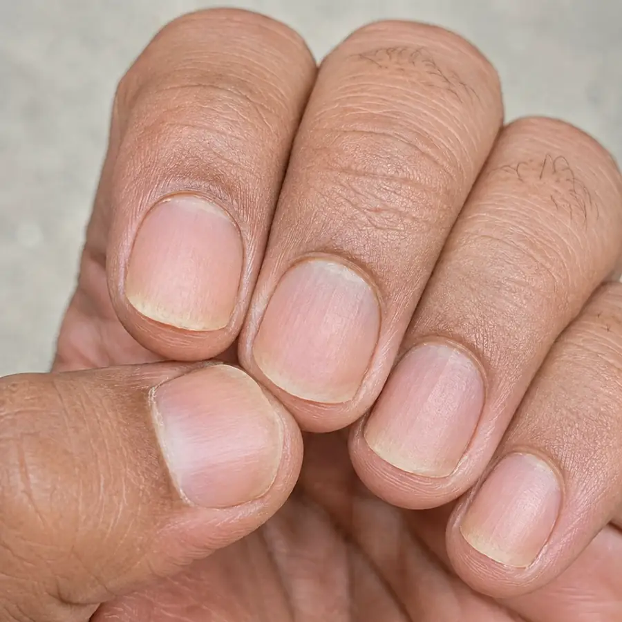 After treatment view showing clearer, healthier nails with reduced psoriasis changes