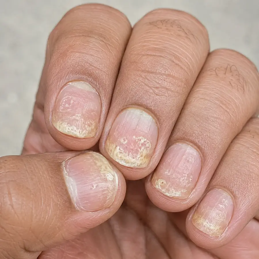 Before treatment view showing brittle, discolored nails with psoriasis changes